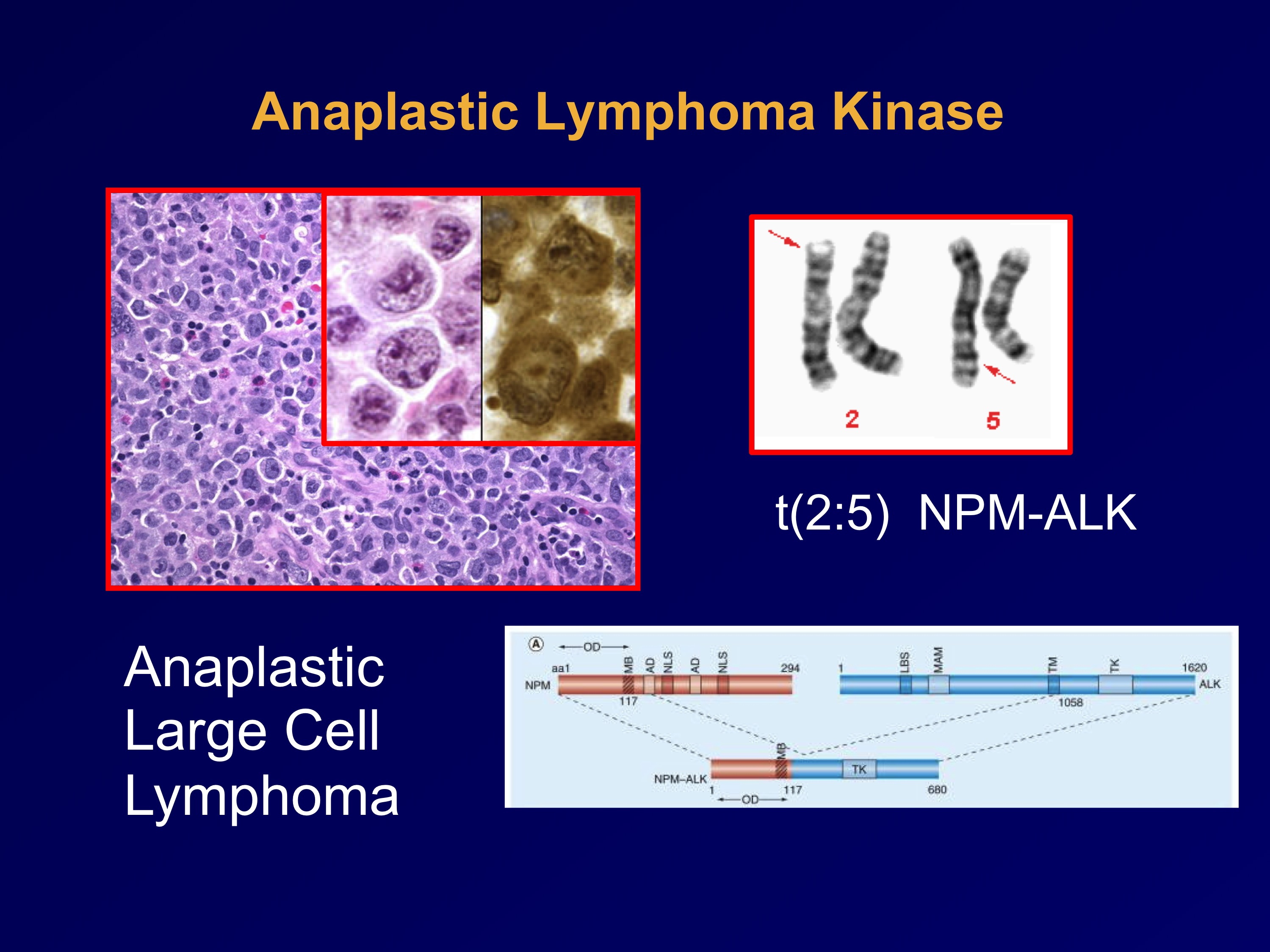 Alk positive lung cancer